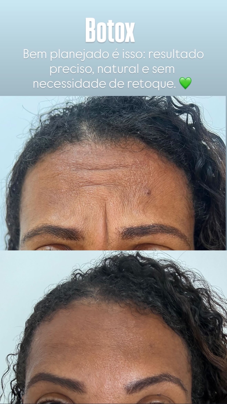 Botox - 24/09/2026