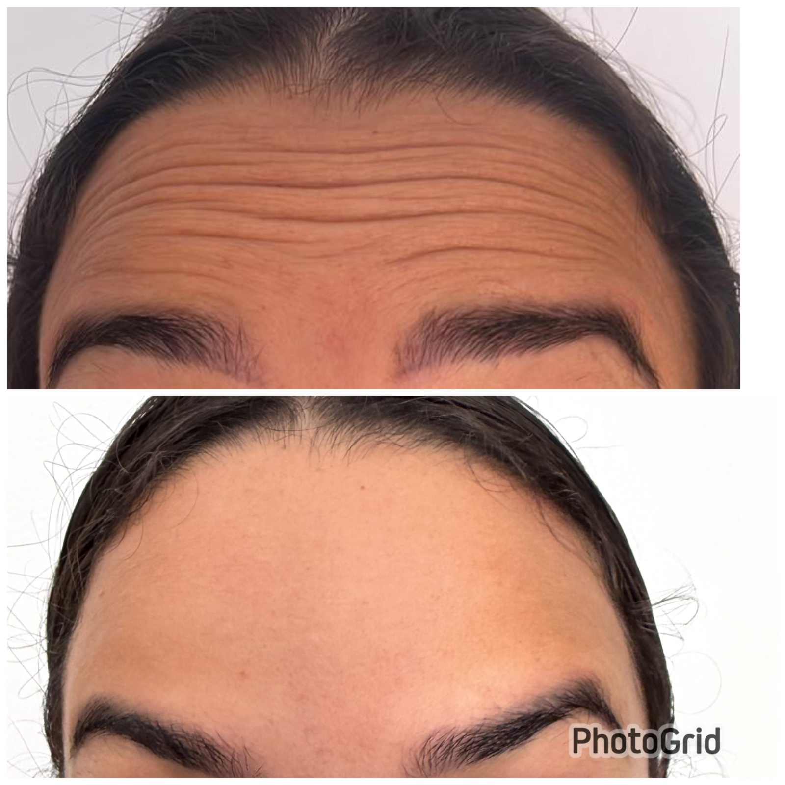 Botox - 24/09/2026
