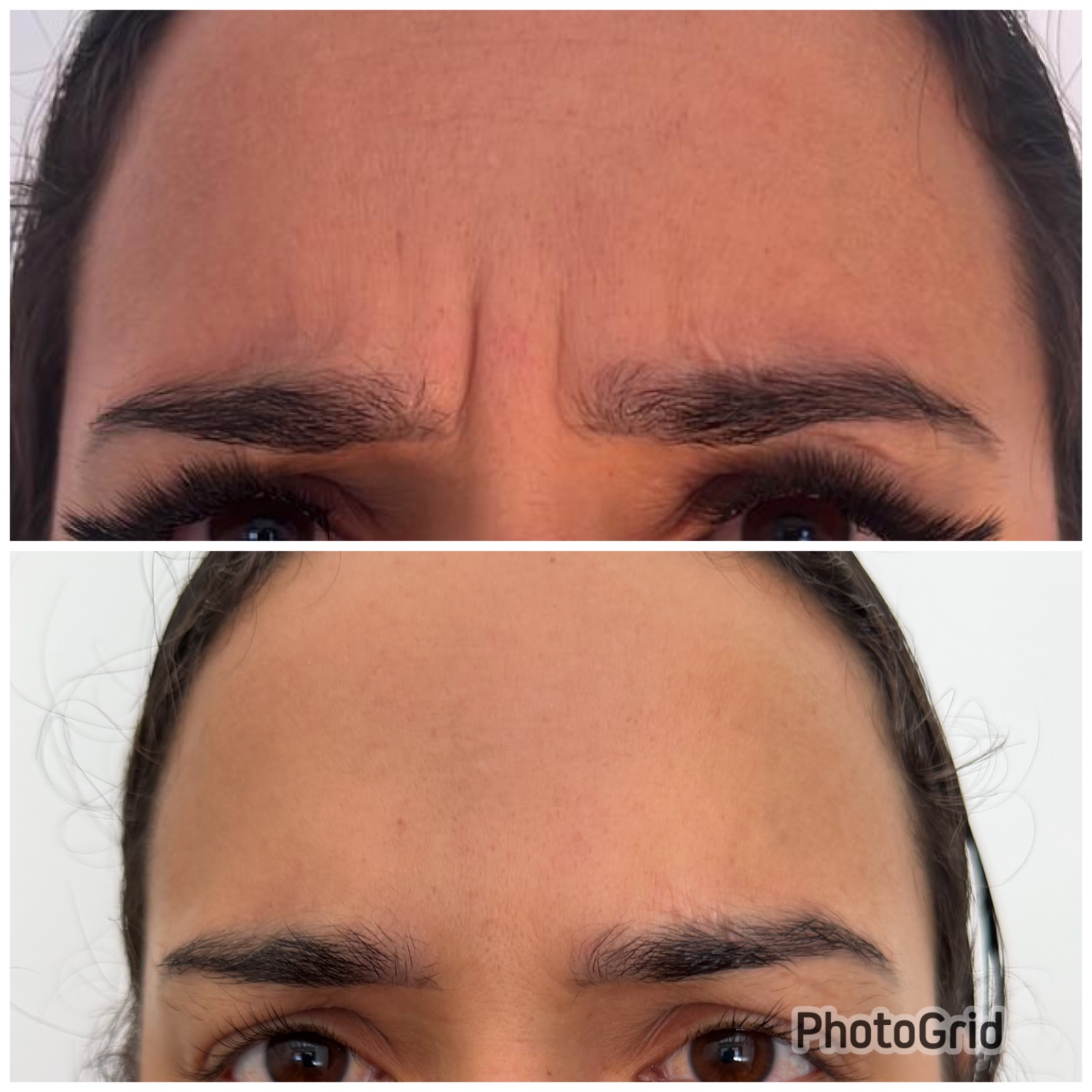 Botox - 24/09/2026